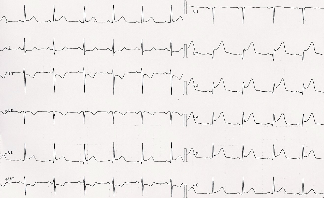 Anteriort stemi akut
