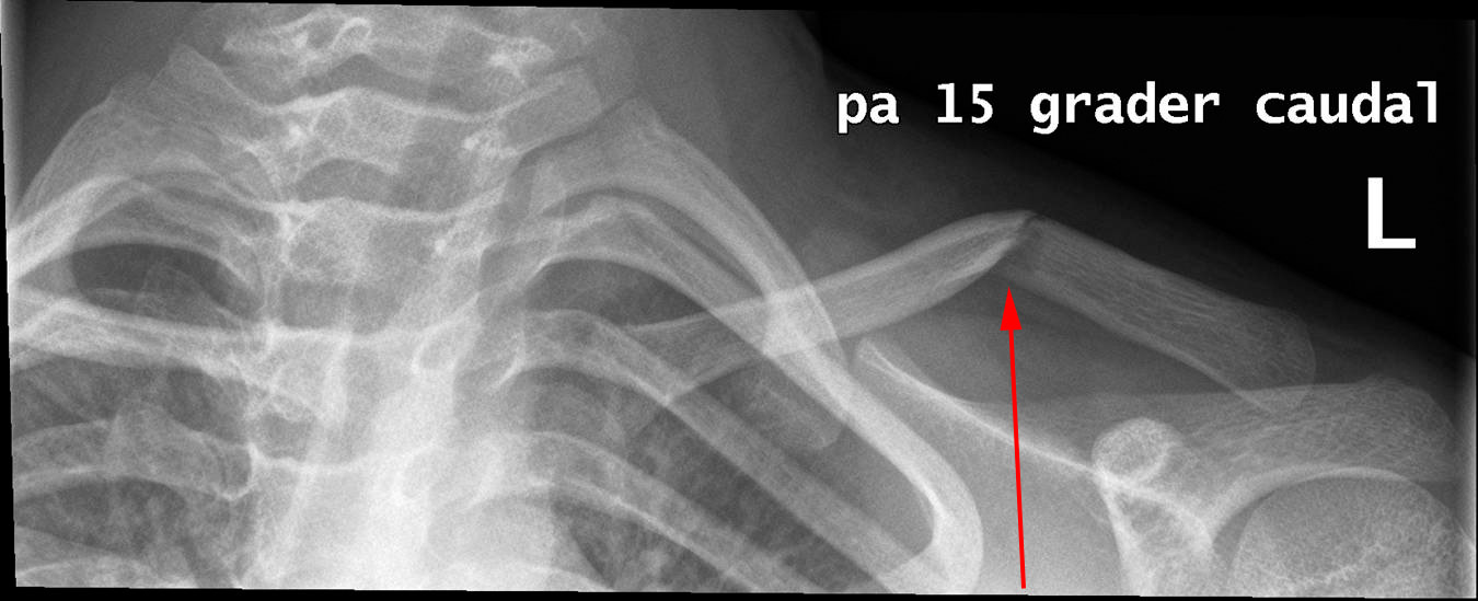 clavicula-brud paa den venstre clavikel efter fald