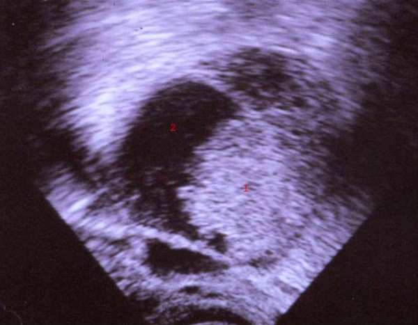 endometroid adenocarcinom-ultralyd