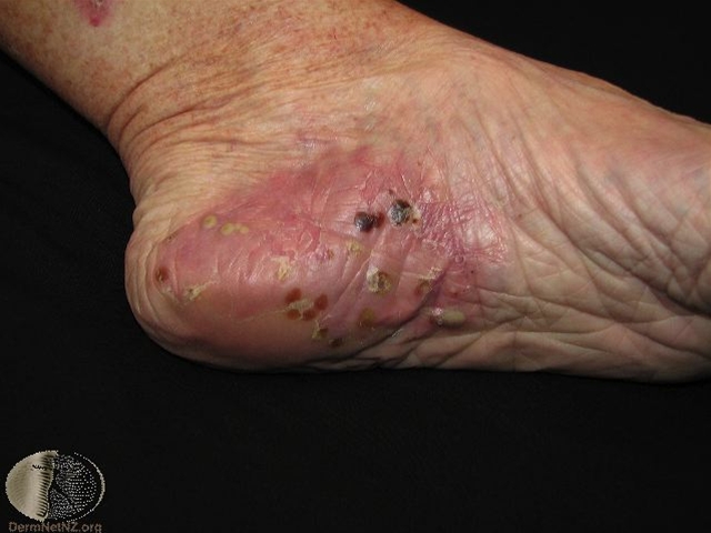pustulosis palmoplantaris 2