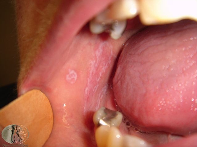 lichen planus mund