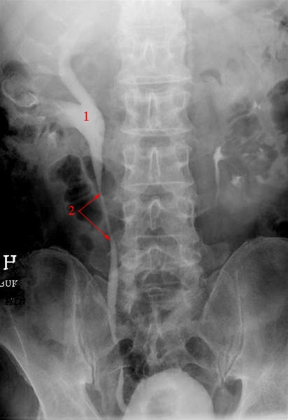 nyrer-hydronefrose-urografi