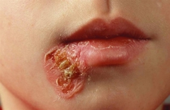 impetigo-ved mund- stort-gult-barn jpg
