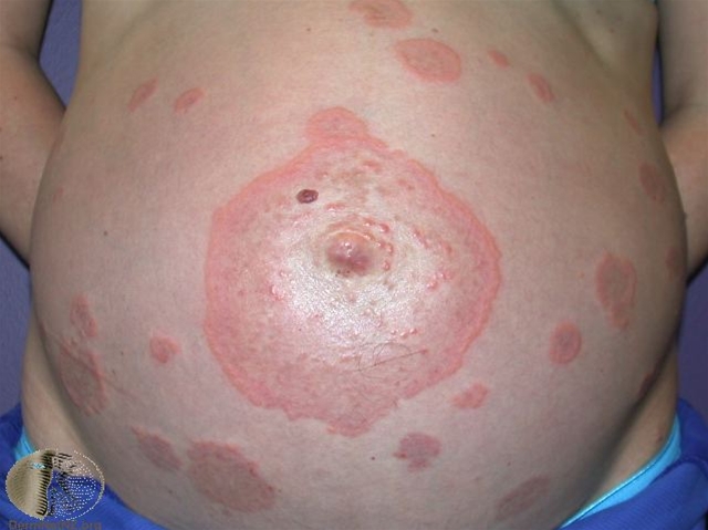 svangerskabs pemfigoid 1