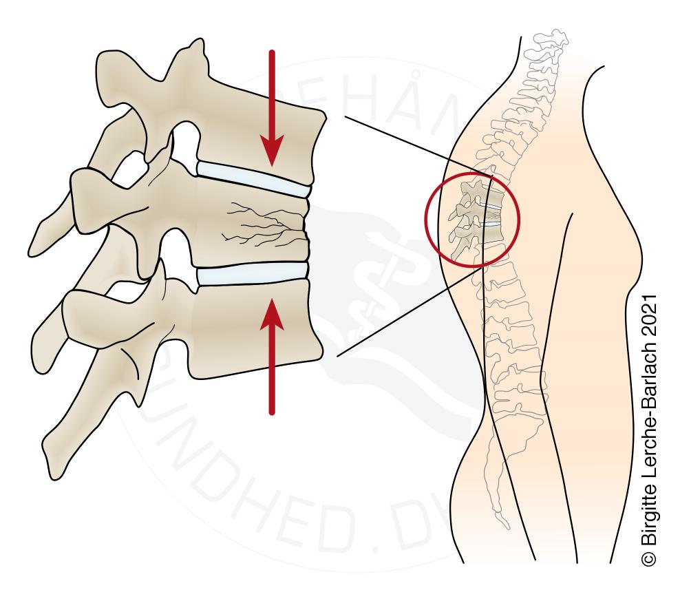 brud-paa-ryghvirvel-pga-osteoporose