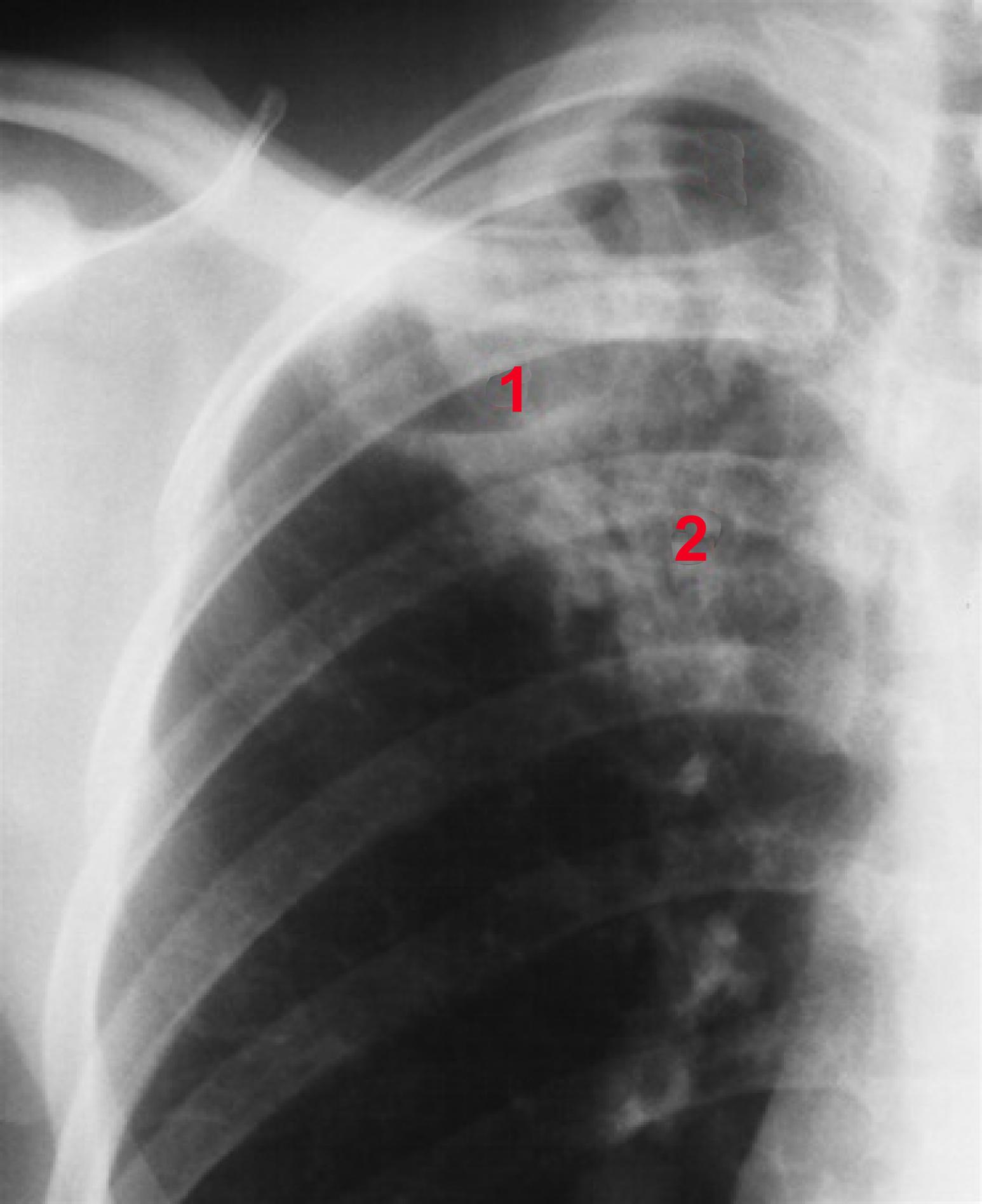 lunge-lungetuberkulose-roentgen