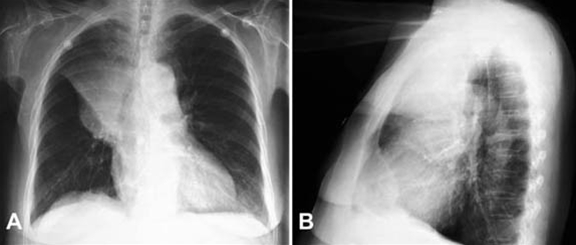 lunger-lungekraeft front og side-roentgen