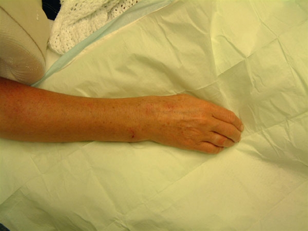 radius - fraktur - fejlstilling