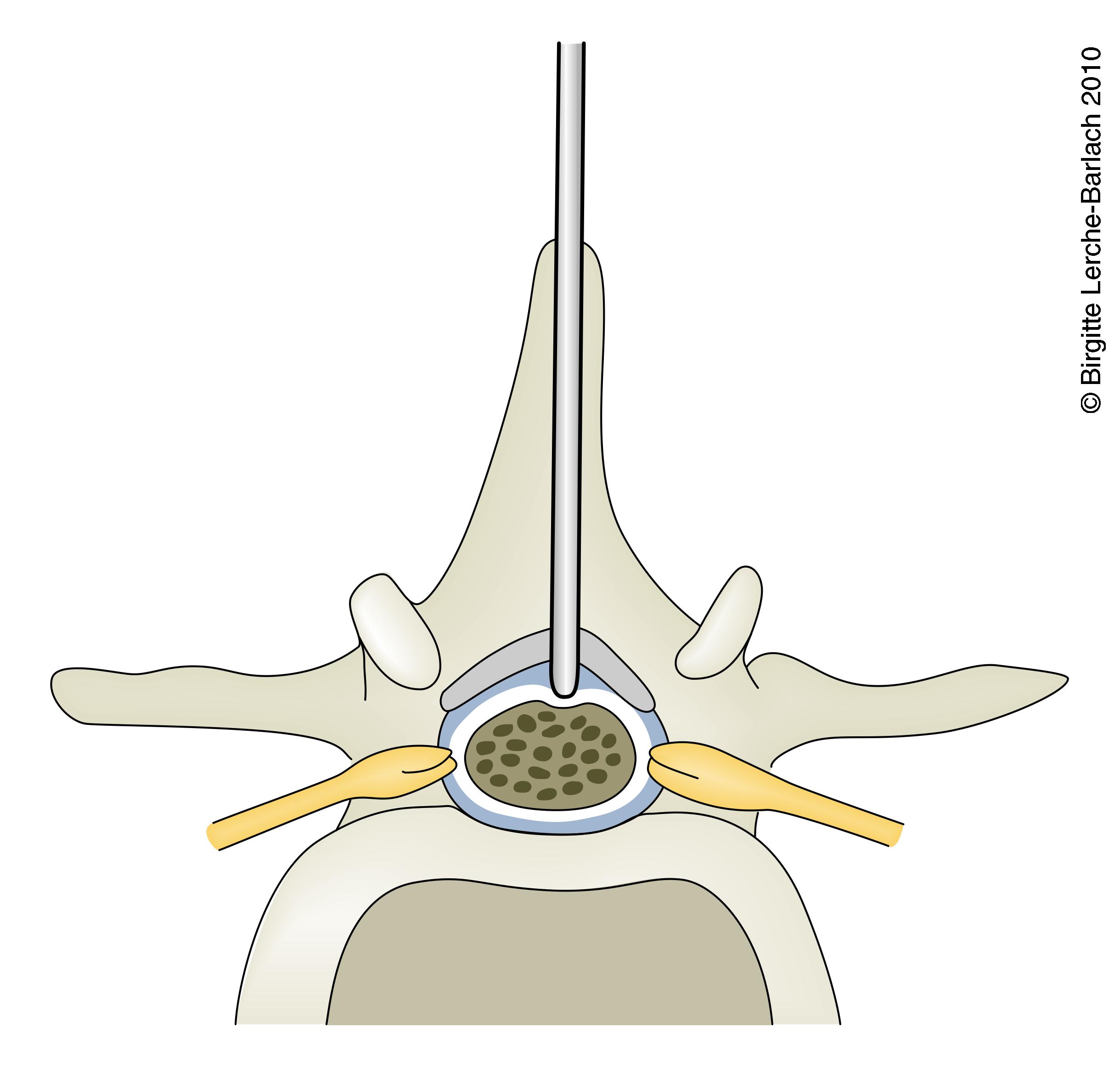 lumbalpunktur-horiso