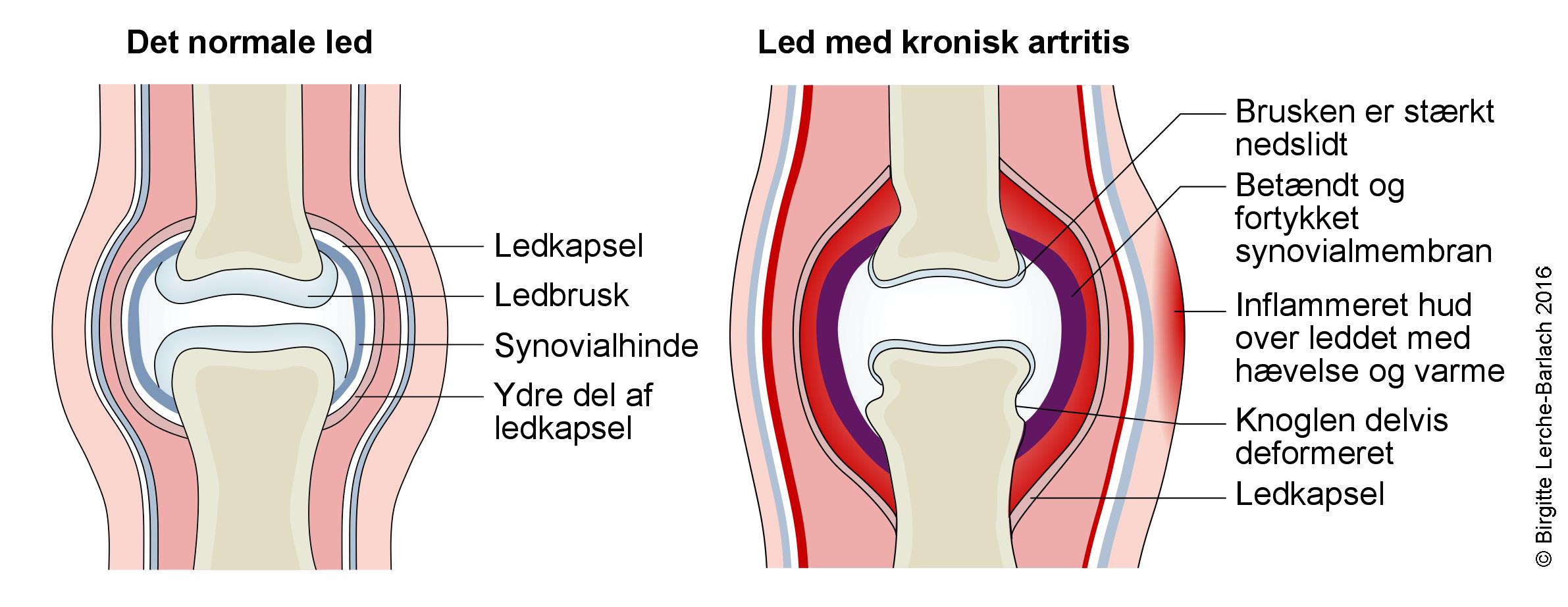 led-kronisk artrit