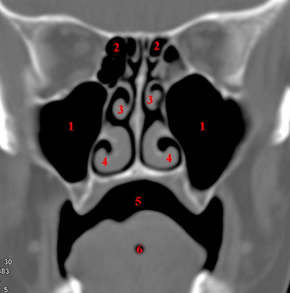 naese-maxillarsinus coronalsnit midterste-ct