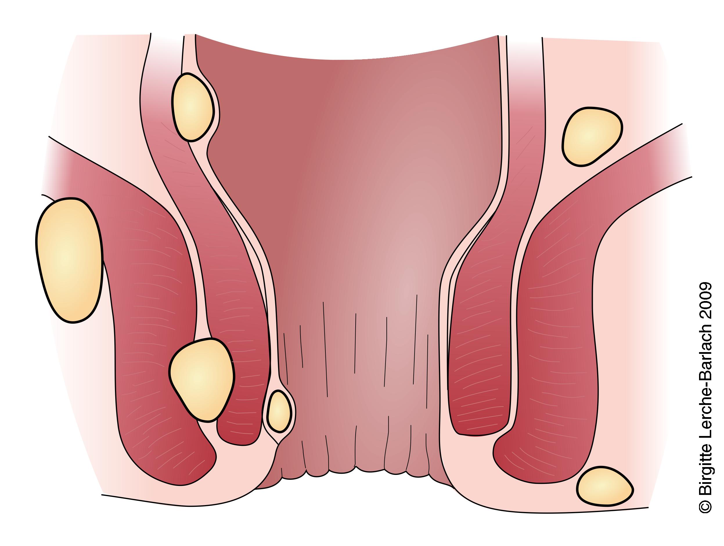 rektum-analabscesser
