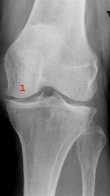 knae-gigt-gonartrose let-rgt