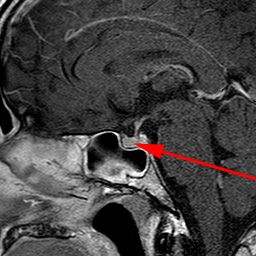 hjerne-normal hypofyse
