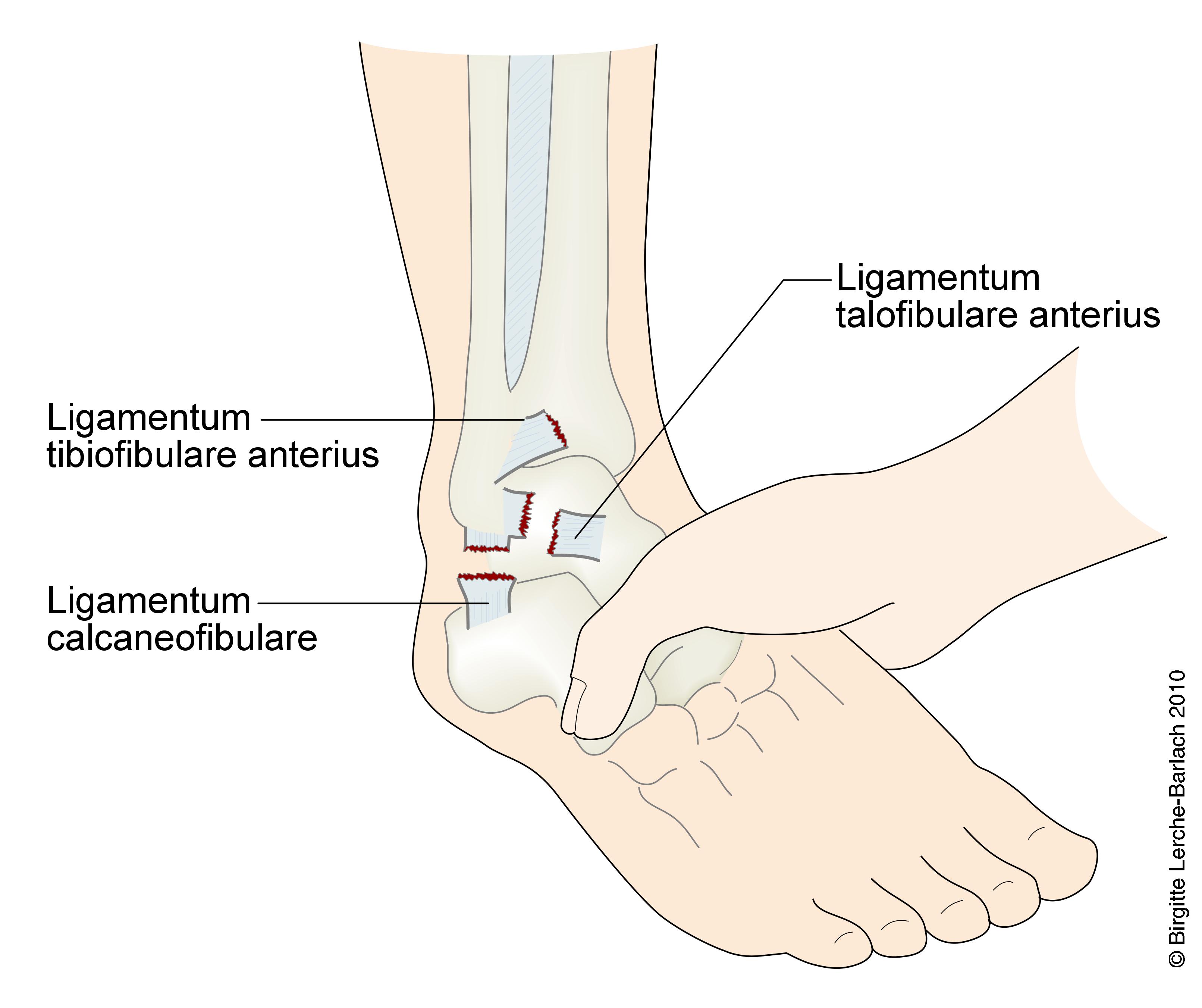 ankel-ruptur af ligamentum talofibulare og calcaneofibulare