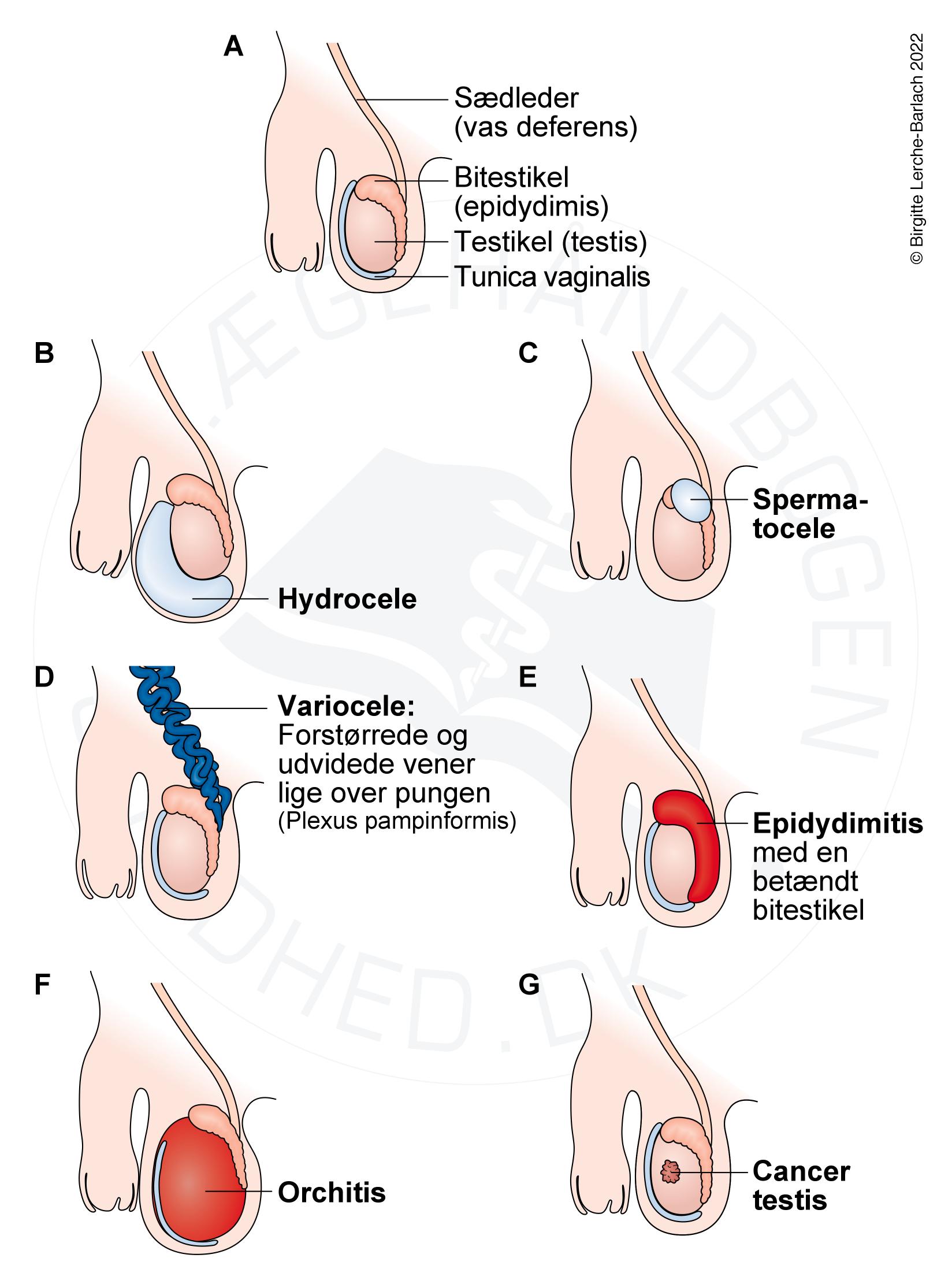 LHid676 Tumor scroti diffdiagnoser
