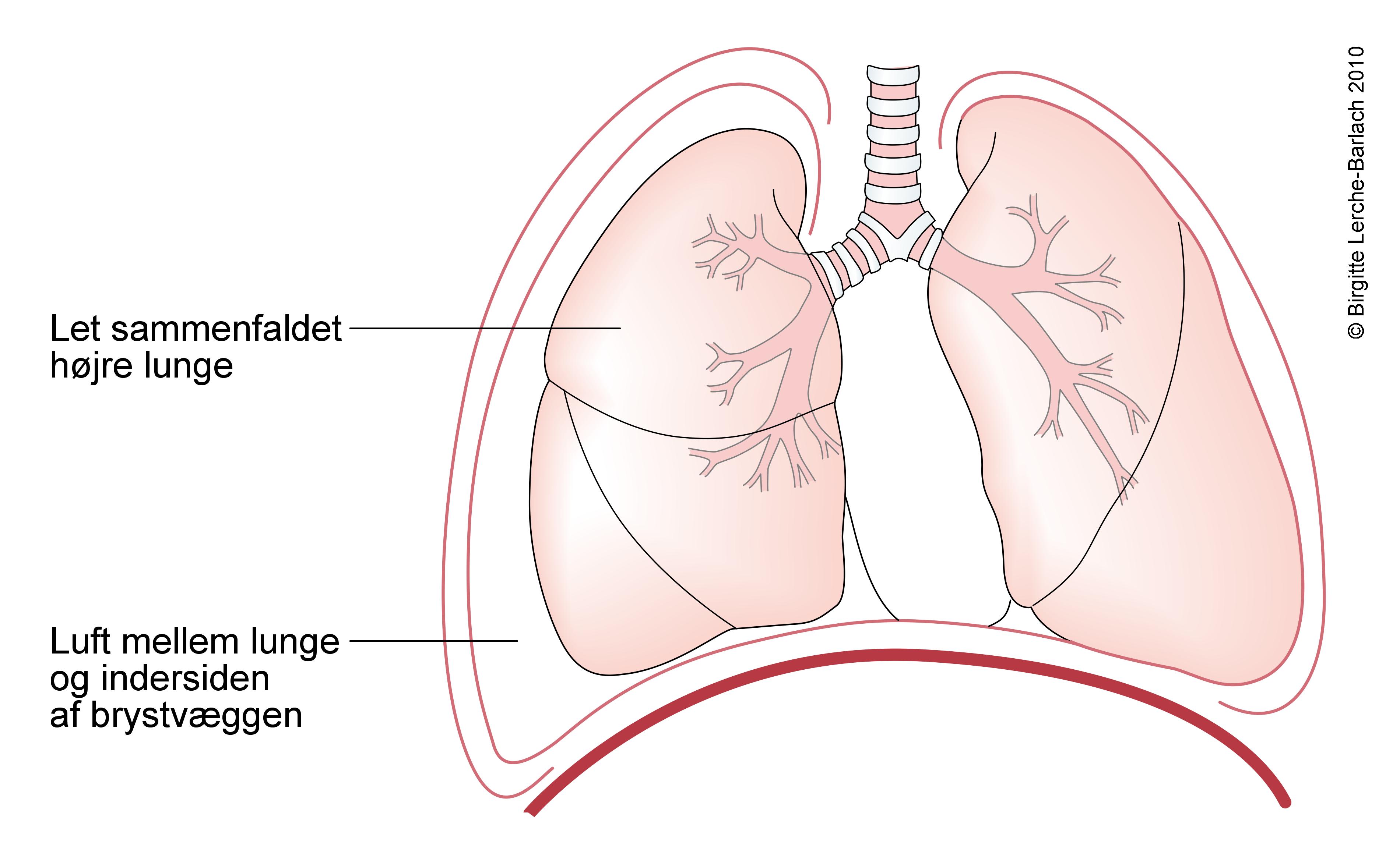lunge- pneumothorax partiel