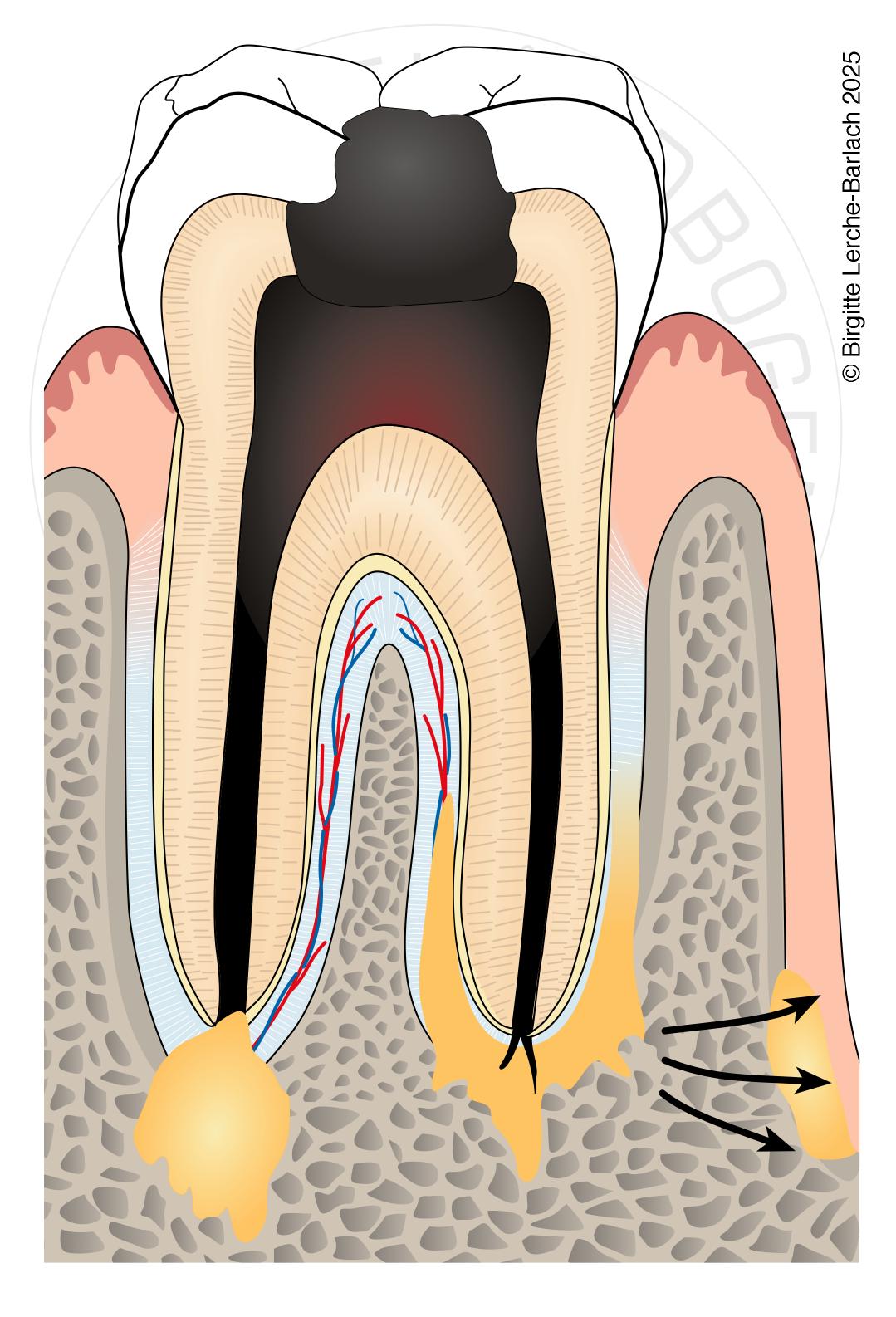 parodontit apikal jpg