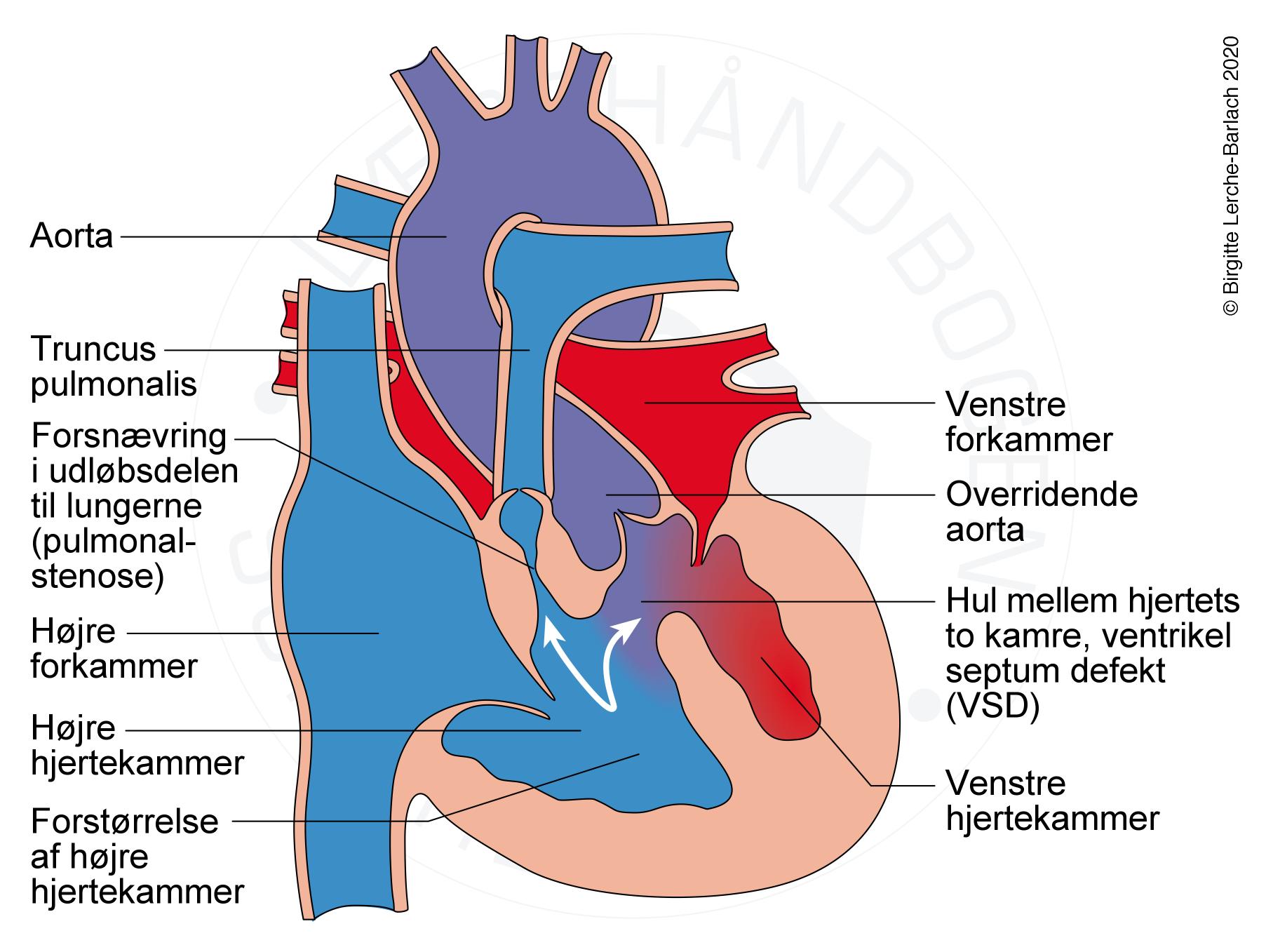 Steno Fallots tetrade