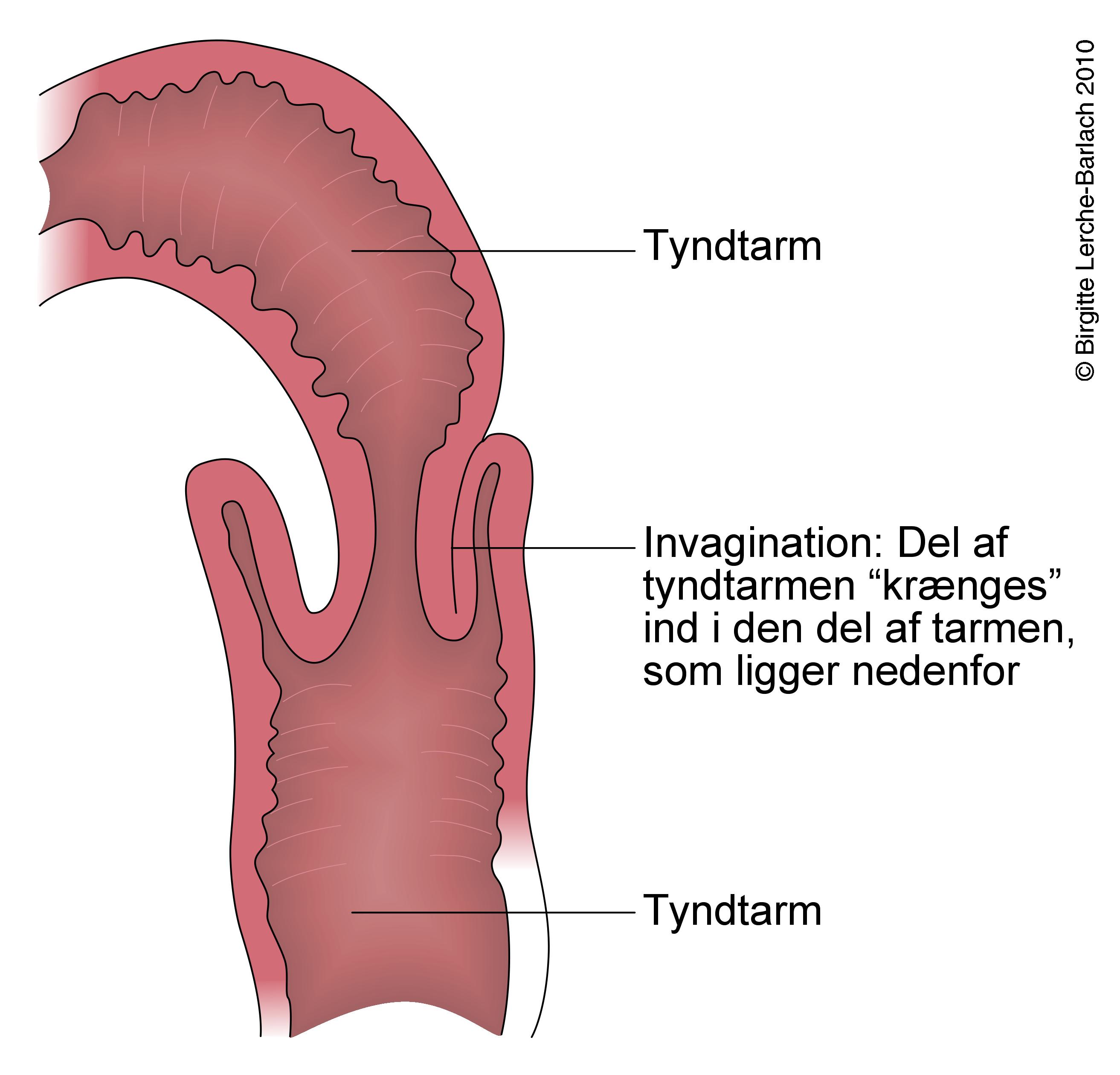 tyndtarm-invagination