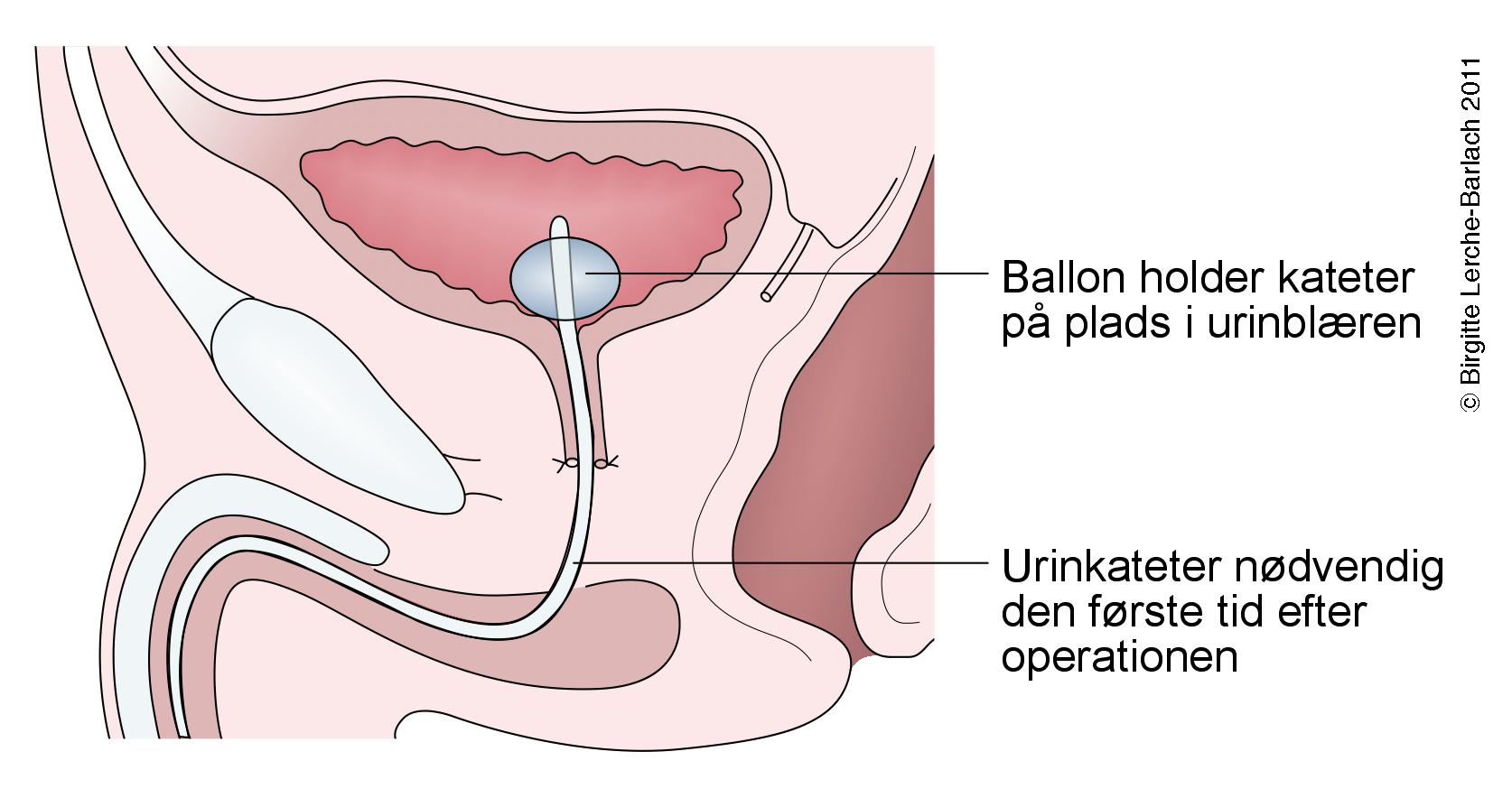 prostata-prostatakirtel fjernet