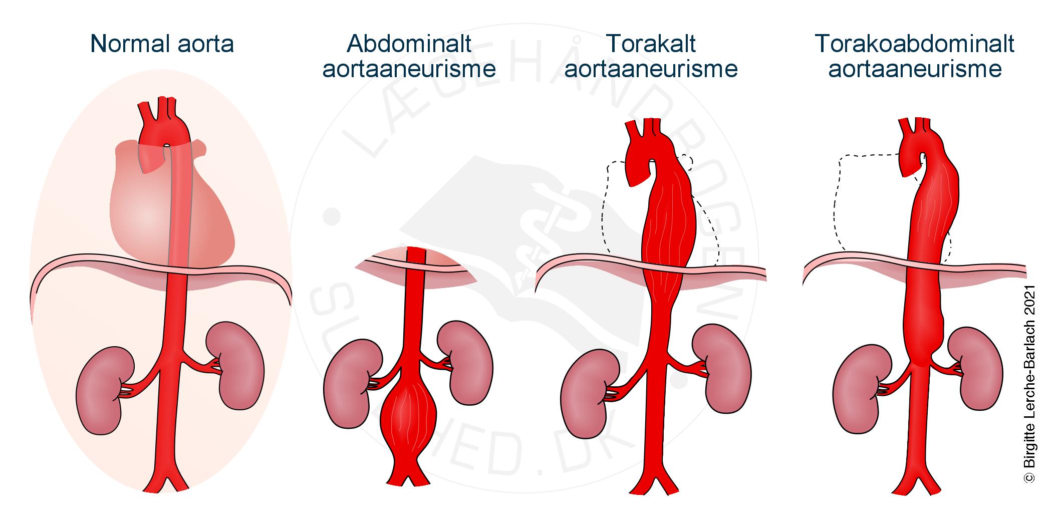 aarer-Definition af aortaaneurismer