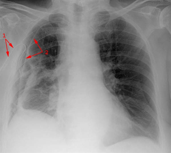 lunger-pneumothorax med draen-roentgen