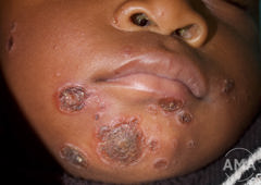 Foto af impetigo på hagen