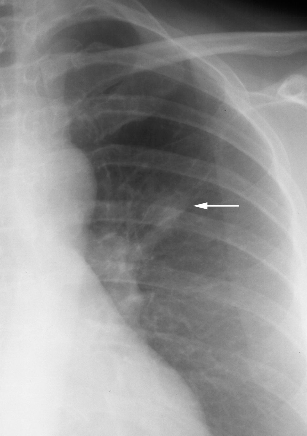 lunger-lungecancer-roentgen