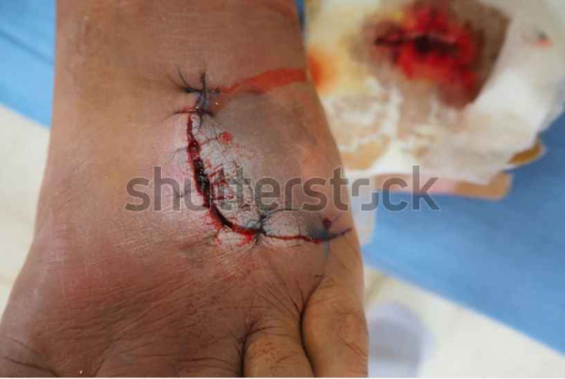 kirurgisk-sårinfektion