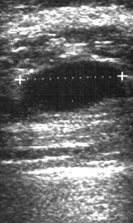 bryst-cyste-ultralyd