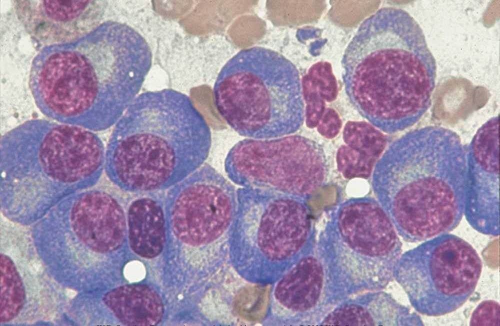 abnorme plasmaceller i knoglemarv fra myelomatosepatient jpg