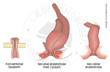 stomi-kirurgiske-muligheder