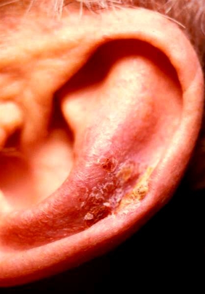 aktinisk keratose-oere