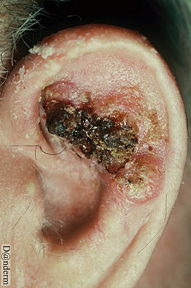 Squamous cell carcinoma on the ear