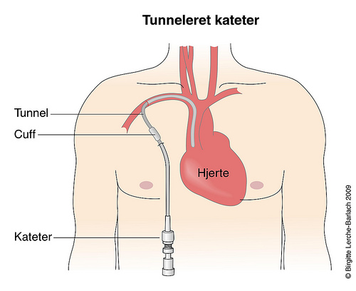 intravasalt kateter