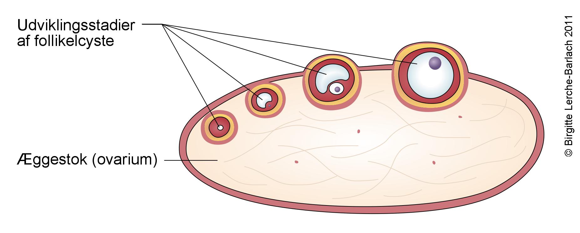 cyste-follikel i aeggestok
