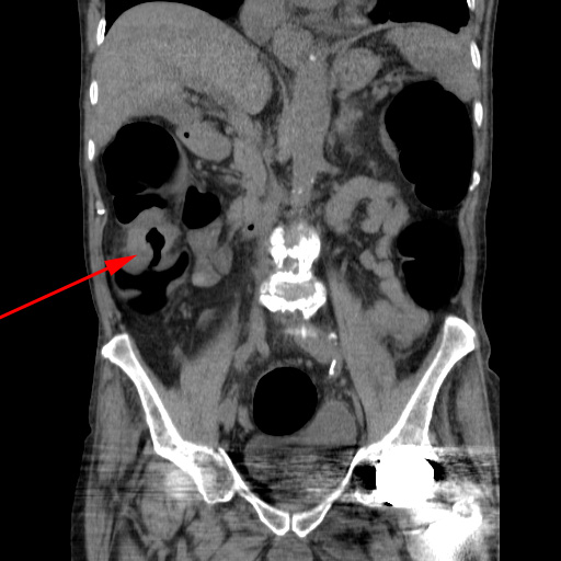colon-tumor i colon ascendens-ct