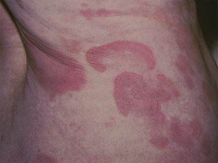 mycosis fungoides-plaque-2