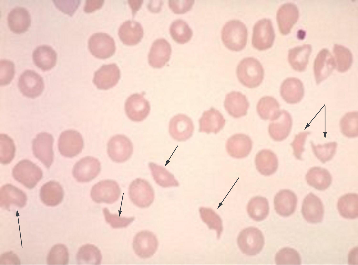 fragmenterede erytrocytter ved ttp jpg