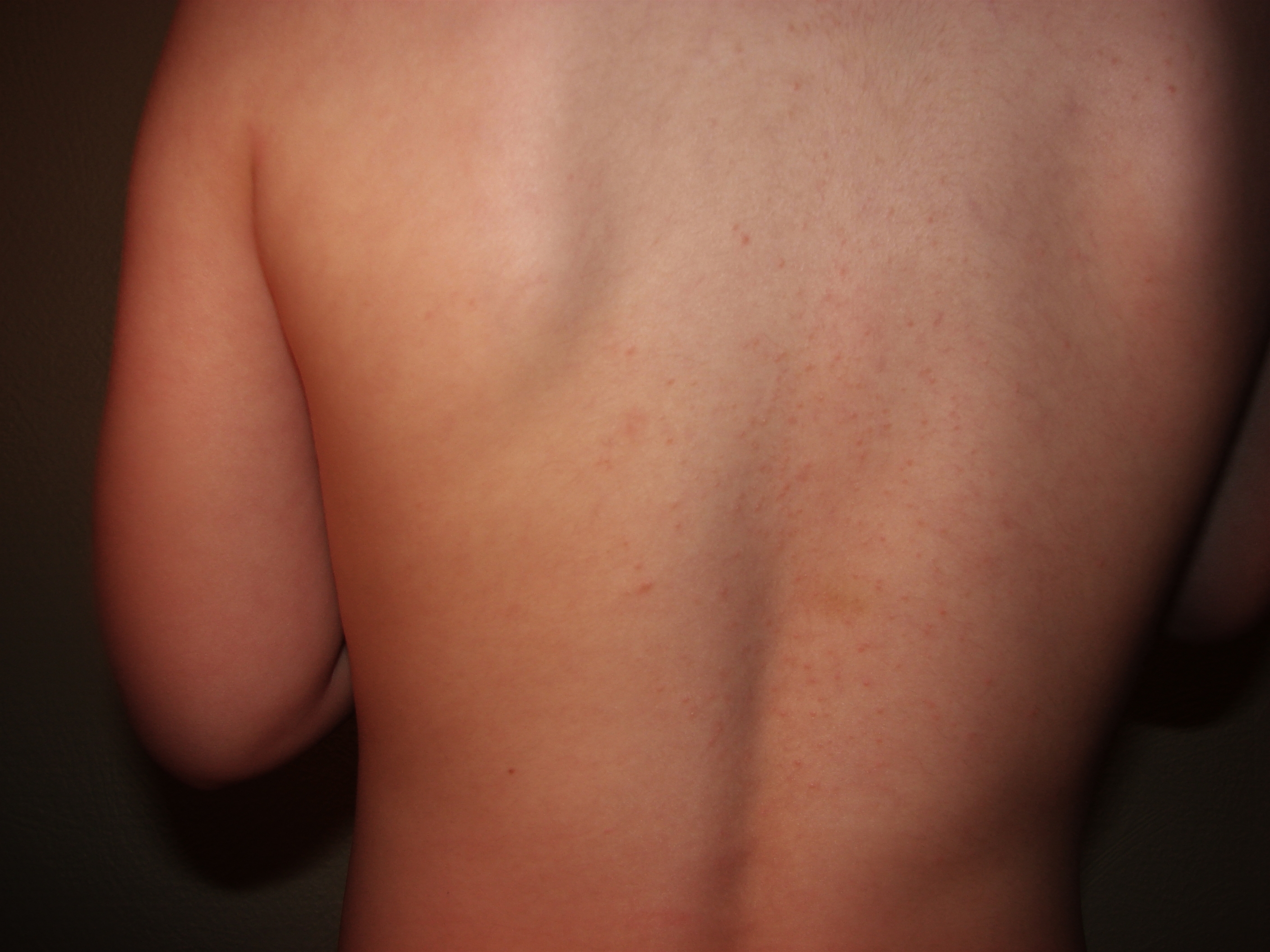 ryg-den femte boernesygdom