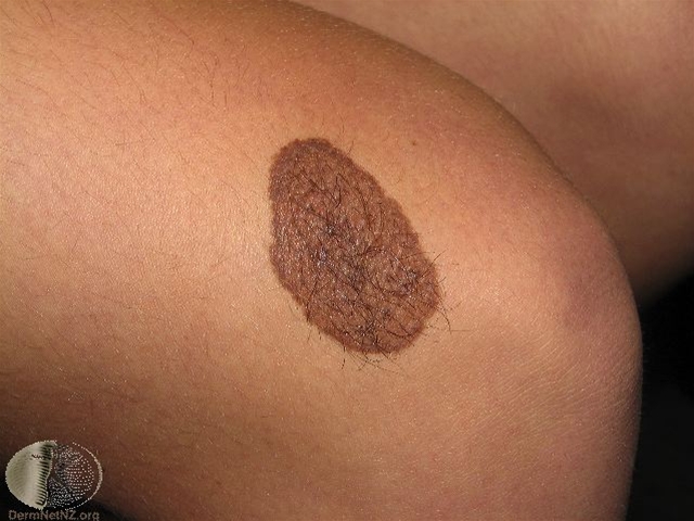 nevus medfoedt