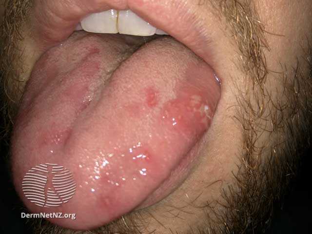 bechet mundhule 50473