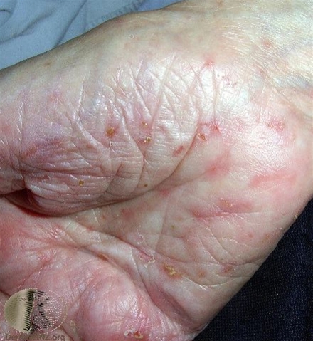 Foto af fnat i håndflade