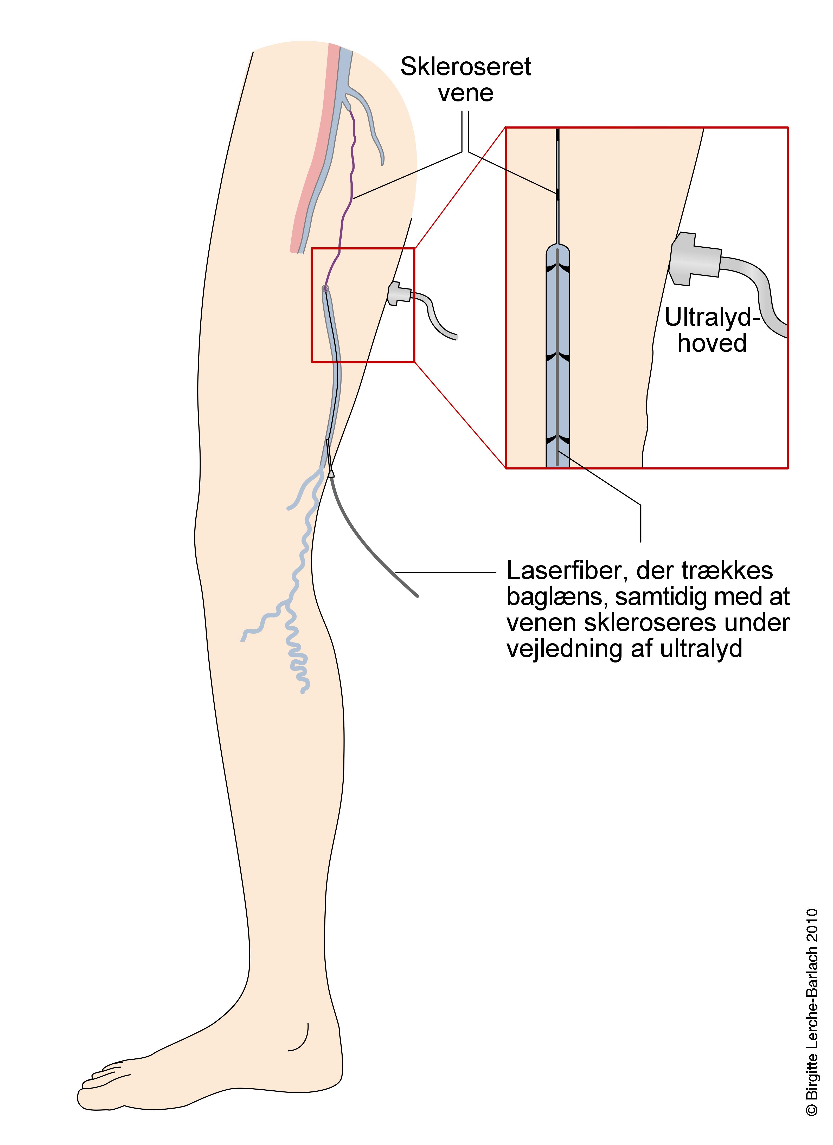 aare-endovenoes behandling af varicer