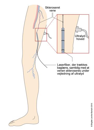 Tegning af ben med udsnit der viser endovenøs behandling af varicer (åreknuder).