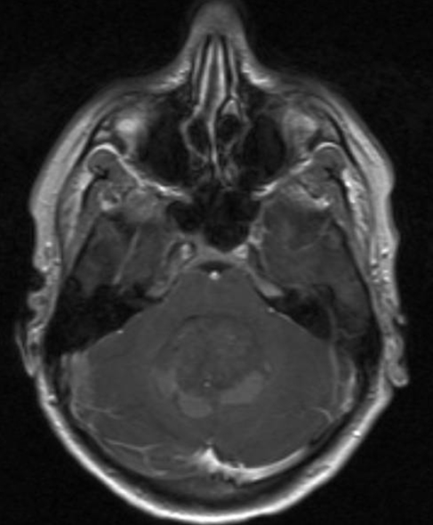 hjerne-medulloblastom-mr