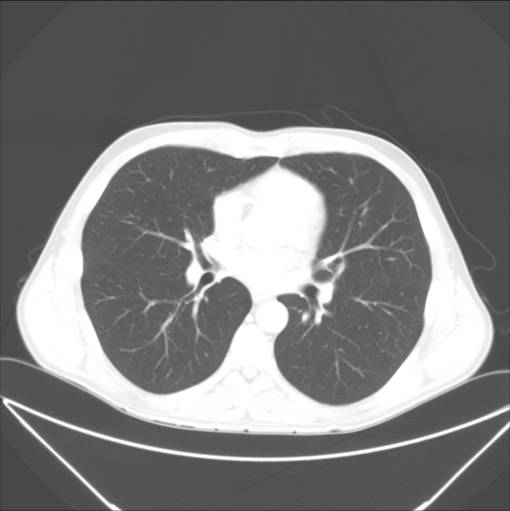 lunger-normal- ct