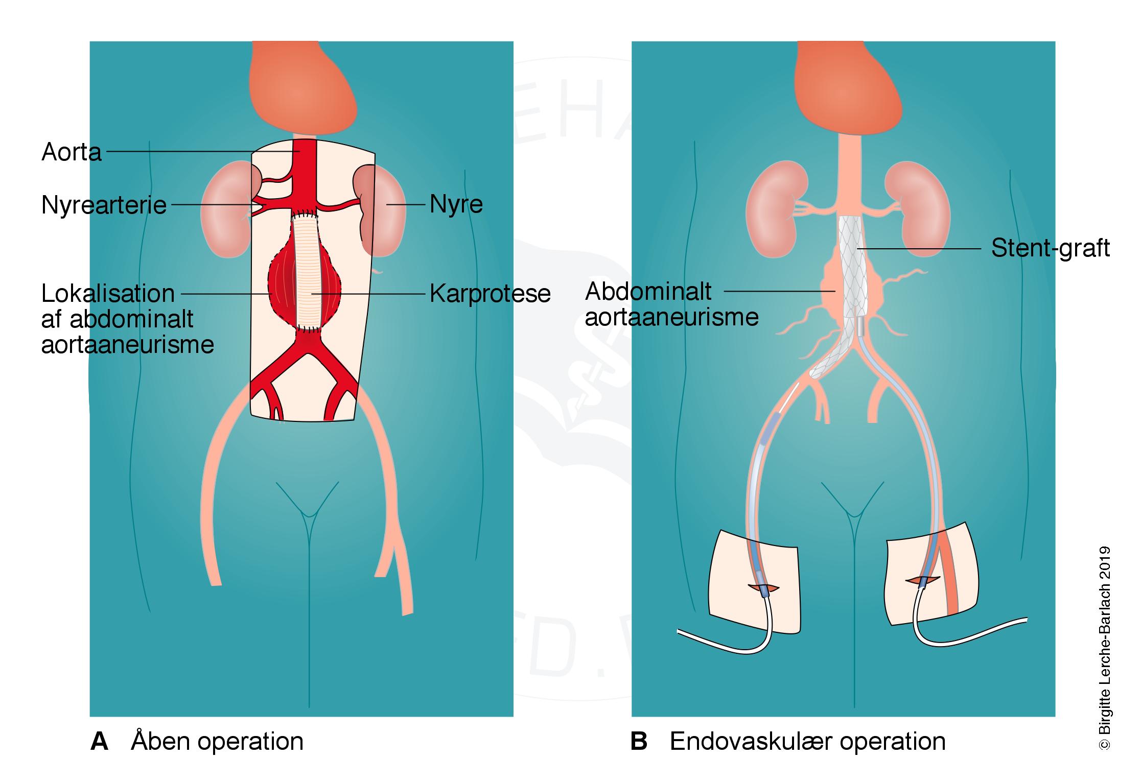 pulsaare-behandling af aortaaneurisme