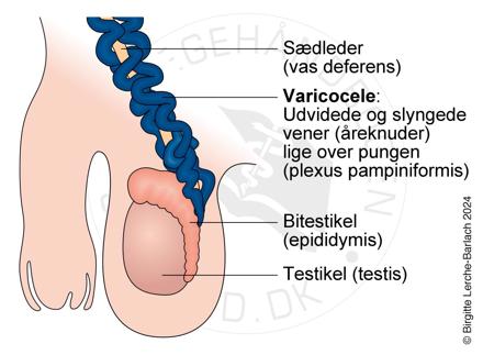 Tegning der viser varicocele i scrotum